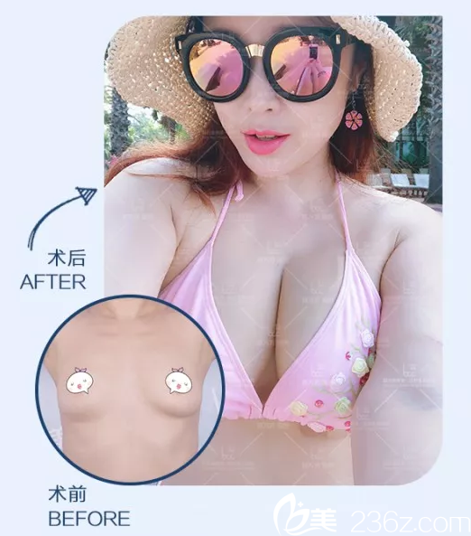 陈万芳自体脂肪丰胸案例 陈万芳自体脂肪丰胸案例