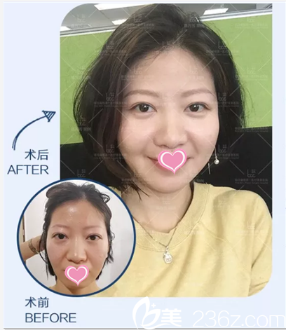 陈万芳自体脂肪面部填充案例 陈万芳自体脂肪面部填充案例