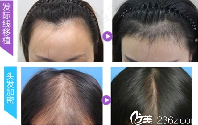 陈善友毛发移植案例