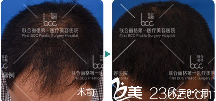 北京联合丽格医疗美容医院张菊芳头发种植案例