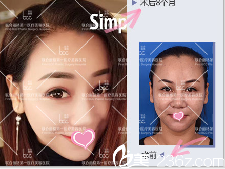 <!--<i data=20240703-sp></i>-->发际线种植案例