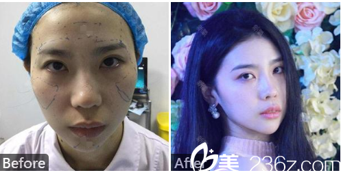 深圳港丹（美诗沁）医疗美容医院王连梅全脸脂肪面部填充案例