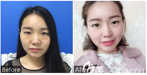 深圳港丹（美诗沁）医疗美容医院王连梅祛眼袋案例