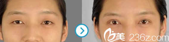 Seven Days整形外科医院双眼皮案例
