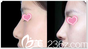 Seven Days整形外科医院假体隆鼻案例