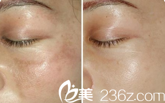 Seven Days整形外科医院激光祛斑案例