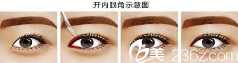 开内眼角过程图 开内眼角过程图