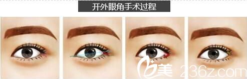 开外眼角过程示意图 开外眼角过程示意图