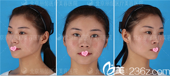 北京米兰柏羽丽都自体脂肪面部填充案例术前照 北京米兰柏羽丽都自体脂肪面部填充案例术前照