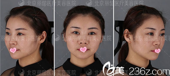 北京米兰柏羽丽都石冰自体脂肪面部填充案例术后7天效果 北京米兰柏羽丽都石冰自体脂肪面部填充案例术后7天效果