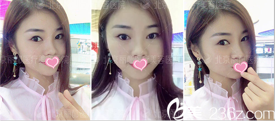 石冰自体脂肪面部填充案例术后30天样子 石冰自体脂肪面部填充案例术后30天样子