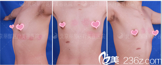 高超自体脂肪丰胸案例 高超自体脂肪丰胸案例