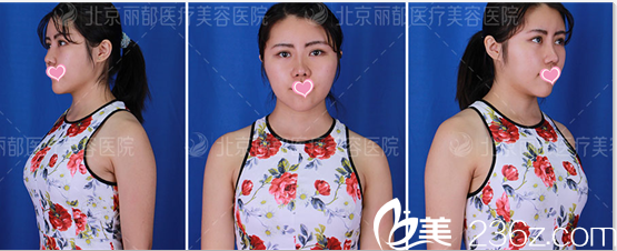 高超自体脂肪丰胸案例术后30天样子 高超自体脂肪丰胸案例术后30天样子