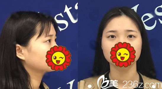 在宁波艺星做双眼皮手术前 在宁波艺星做双眼皮手术前