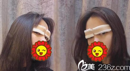 刚做完双眼皮手术照片 刚做完双眼皮手术照片