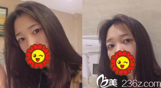 在宁波艺星做双眼皮术后3天 在宁波艺星做双眼皮术后3天