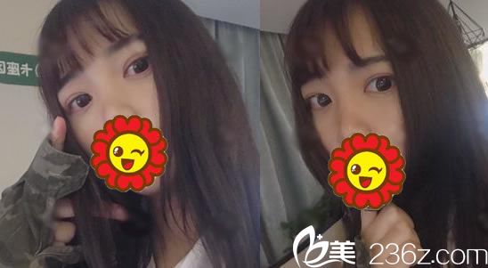 在艺星做全切双眼皮术后30天 在艺星做全切双眼皮术后30天