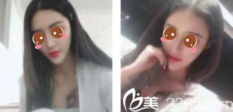 上海星采医疗美容门诊部刘新玉假体隆鼻真人案例术后两个月