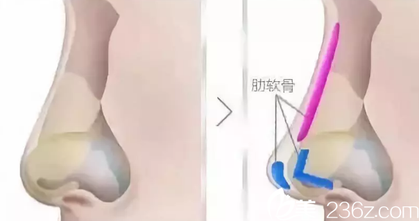 肋软骨隆鼻手术