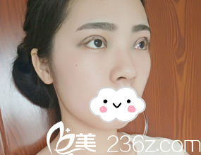 潍坊华美整形美容医院任传琦全切双眼皮术后天的眼睛真的好肿 