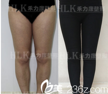我在北京禾力康做了腿部吸脂手术,给你看术前术后50天对比照