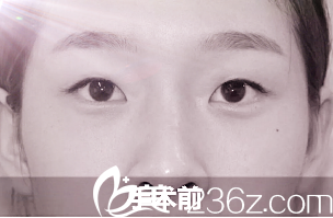 术前单眼皮的我 术前单眼皮的我