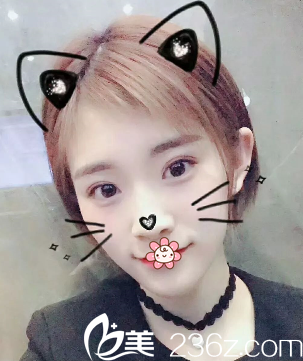 重庆华美双眼皮术后13天 重庆华美双眼皮术后13天