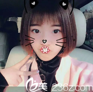 重庆华美李富强双眼皮术后28天 重庆华美李富强双眼皮术后28天