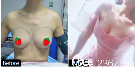 深圳睿京医疗美容整形医院王海自体脂肪隆胸案例图