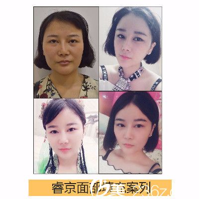 深圳睿京医疗美容整形医院王海自体脂肪全脸填充案例图