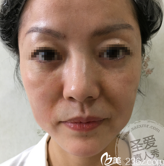 术前面部衰老明显 术前面部衰老明显