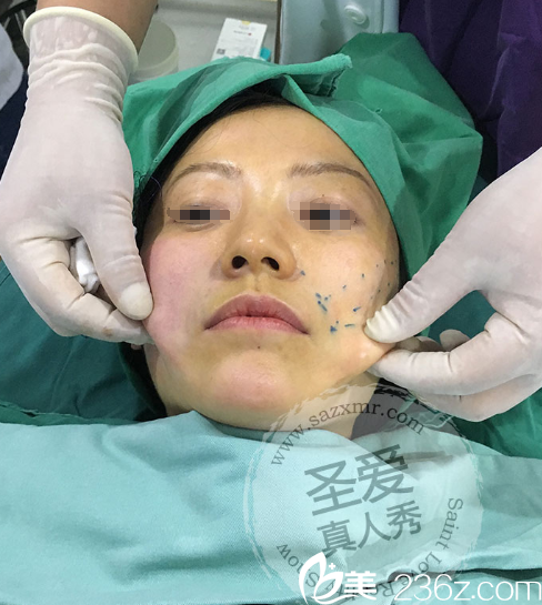 胜院长面部提升手术过程中 胜院长面部提升手术过程中