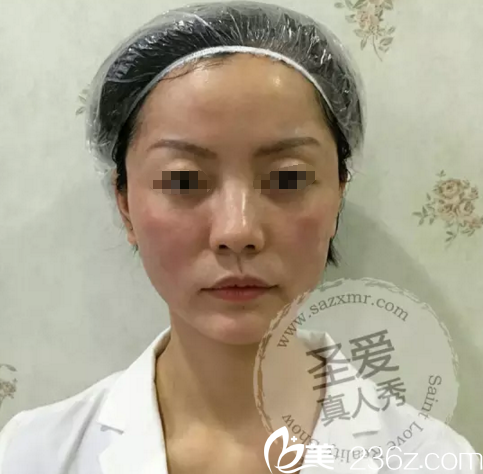 埋线提升术后即刻效果 埋线提升术后即刻效果