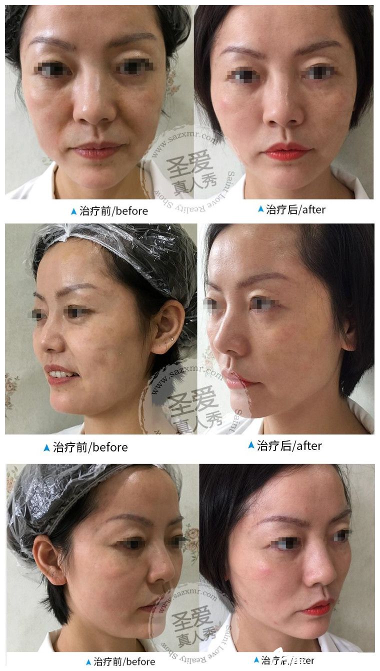 在<!--<i data=20240703-sp></i>-->做面部埋线提升术后一周恢复 在<!--<i data=20240703-sp></i>-->做面部埋线提升术后一周恢复