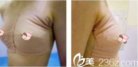 上海馨美医疗美容门诊部王晓阳自体脂肪隆胸真人案例术后第三天