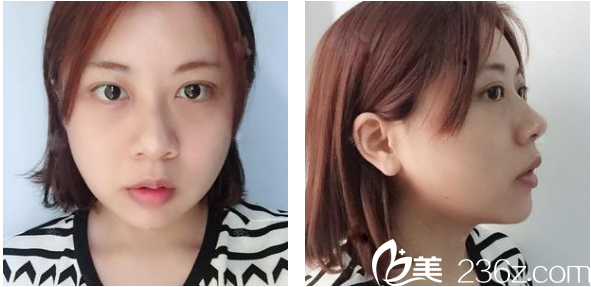 深圳科美丽格徐斌磨颧骨下颌角术后一个月消肿图片