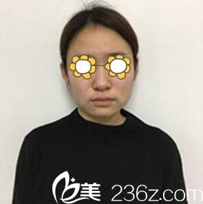 下颌角整形术前照 下颌角整形术前照