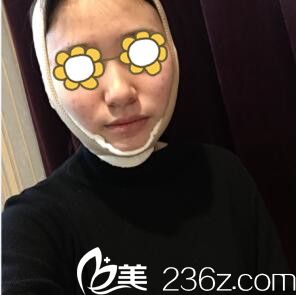 轮廓整形术后3天效果 轮廓整形术后3天效果