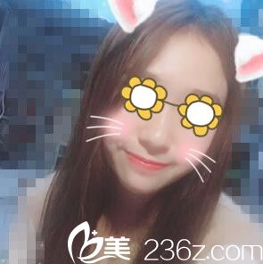 在美贪做下颌角术后1个月效果 在美贪做下颌角术后1个月效果