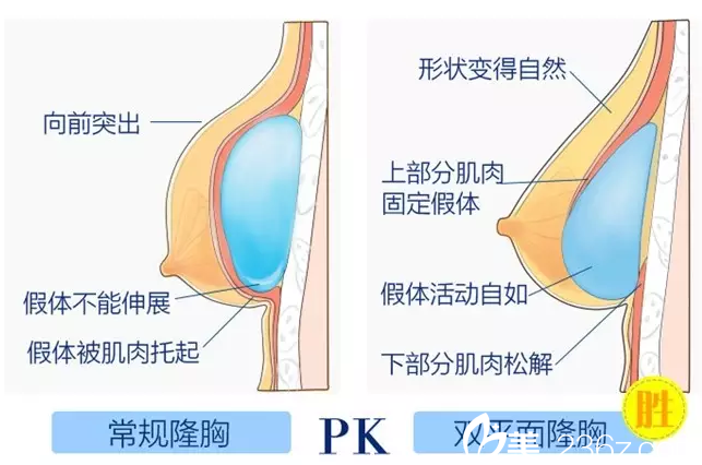 在南宁梦想做假体隆胸手术优势 在南宁梦想做假体隆胸手术优势