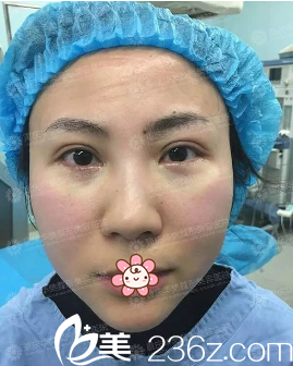 去完眼袋即刻 去完眼袋即刻