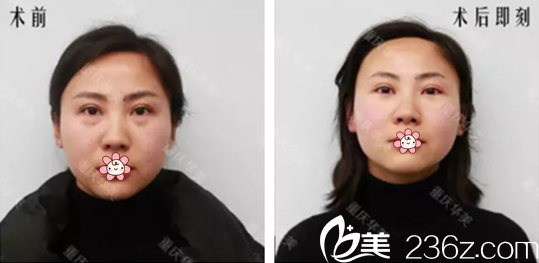 重庆华美激光祛眼袋术前术后对比 重庆华美激光祛眼袋术前术后对比