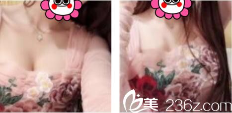 上海新星吴坤南为我做的自体脂肪隆胸，术后三个月乳沟清晰可见