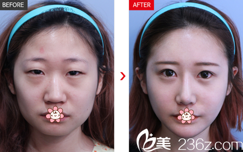 朴德俊院长双眼皮隆鼻案例 朴德俊院长双眼皮隆鼻案例