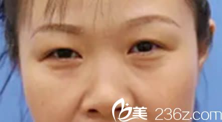 在厦门脸博士整形医院做眼鼻整形术前照 在厦门脸博士整形医院做眼鼻整形术前照