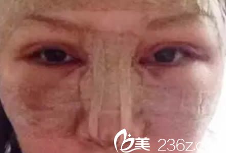 做完双眼皮和假体隆鼻第2天的样子 做完双眼皮和假体隆鼻第2天的样子