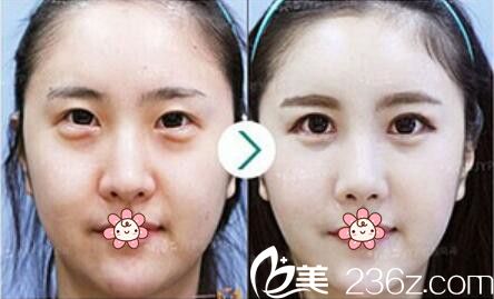 朴炳浩院长眼底脂肪祛除案例 朴炳浩院长眼底脂肪祛除案例