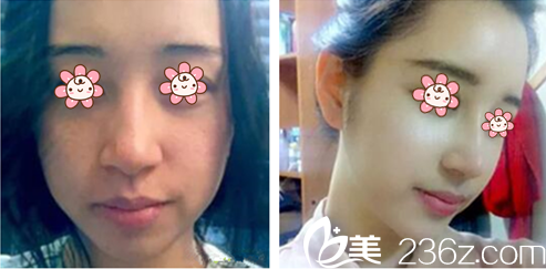 徐东麟院长隆鼻案例 徐东麟院长隆鼻案例