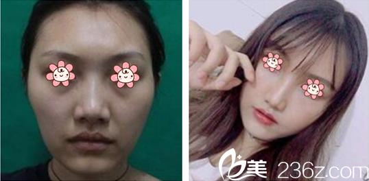 洪龙泽院长面部脂肪填充案例