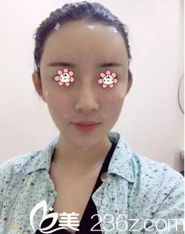 胡煜医生给我填充完当天 胡煜医生给我填充完当天